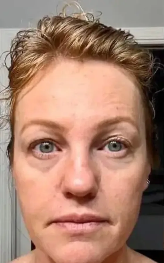 Customer's skin before using Activated Liquid Collagen